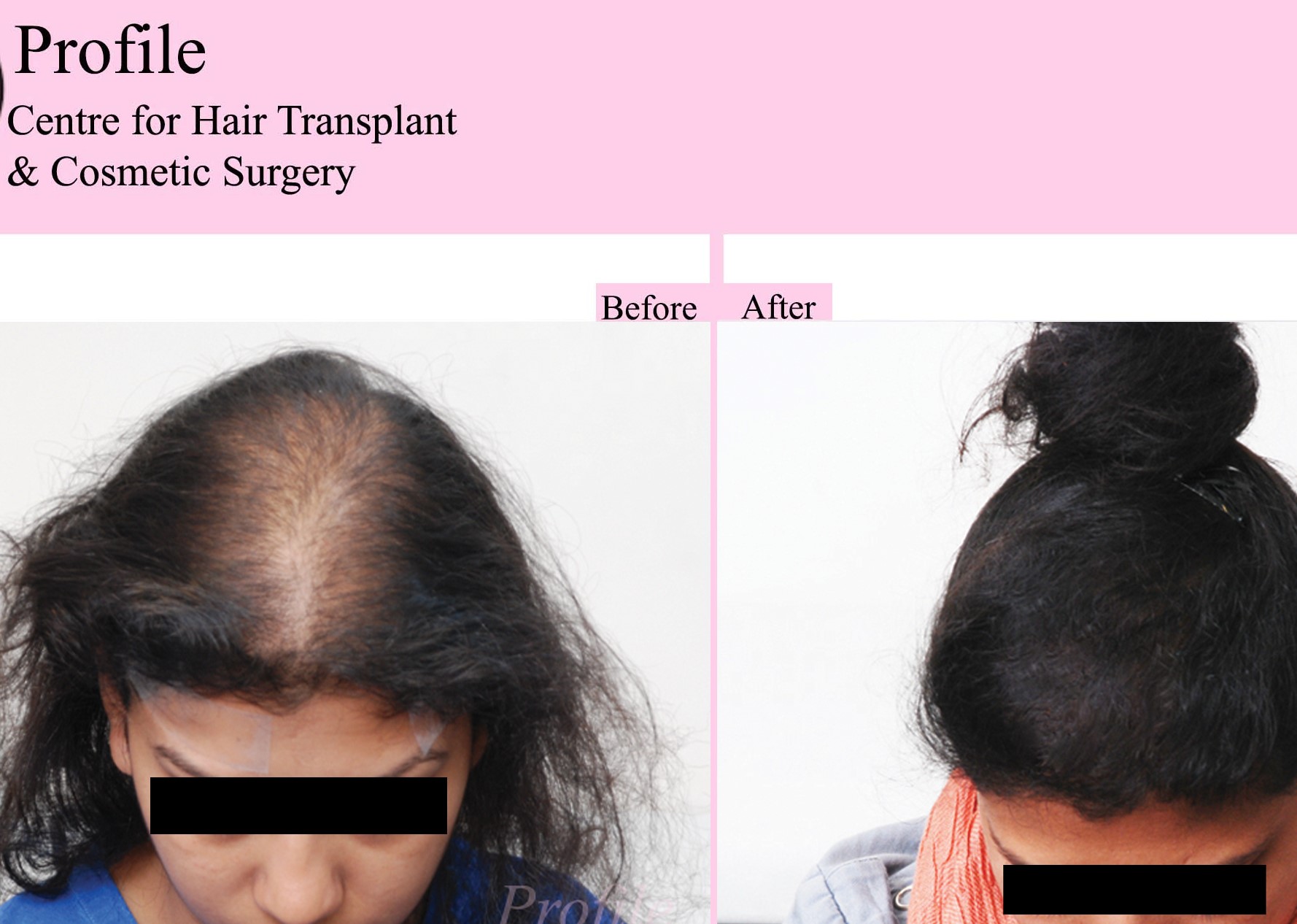 Profile Hair Transplant Centre